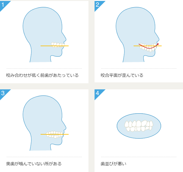 1.咬み合わせが低く前歯があたっている 2.咬合平面が歪んでいる 3.奥歯が噛んでいない所がある 4.歯並びが悪い