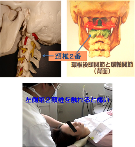 1 97%の方が左側の首の骨の2番目（頚椎2番目:歯突起）に圧痛があります。