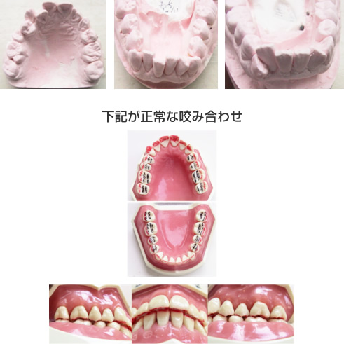1 歯列不正（歯並び悪い）と歯を磨いても歯周病に なりやすいのです。