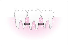  正常な状態は歯と歯の間に骨があります。