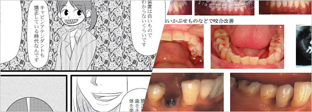 歯を削らず貼り付ける治療方法ラミネートベニア