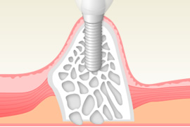 インプラント治療はこちらをご覧ください。