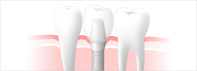 横の歯に負担がかからないインプラント治療